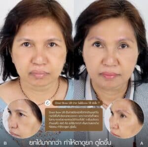 รีวิว Sub Brow Lift ที่ Elite Clinic