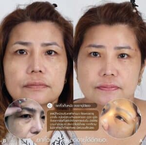 รีวิว Sub Brow Lift ที่ Elite Clinic