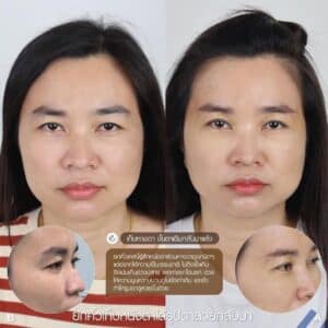 รีวิว Sub Brow Lift ที่ Elite Clinic