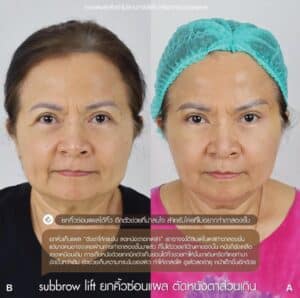 รีวิว Sub Brow Lift ที่ Elite Clinic