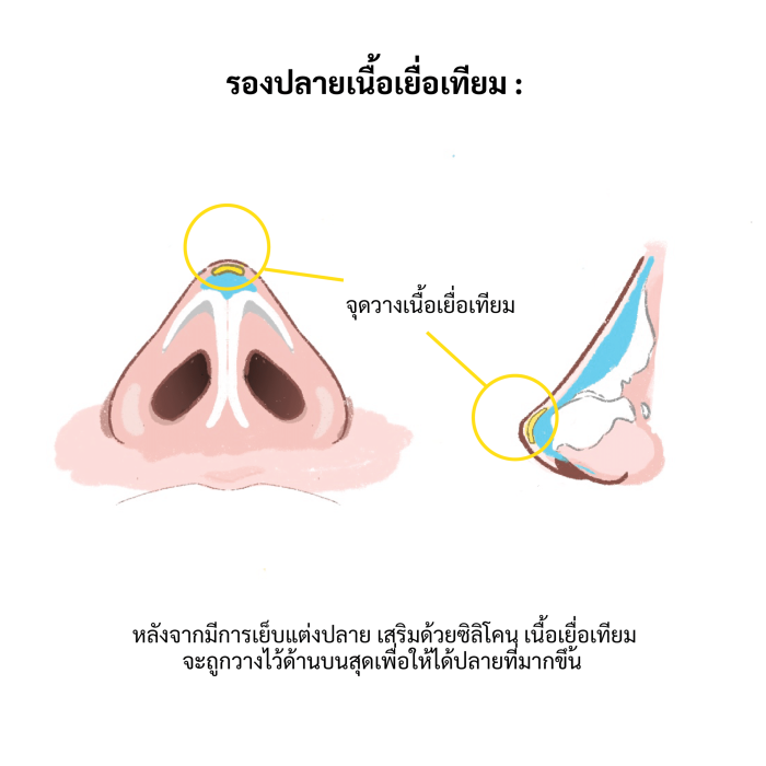 รองปลายด้วยเนื้อเยื่อ อีลิทคลินิก