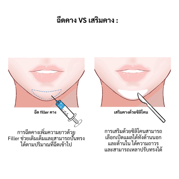 เสริมคาง หรือ ฉีดคาง อีลิทคลินิก
