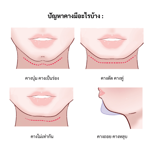 ปัญหาคาง อีลิทคลินิก
