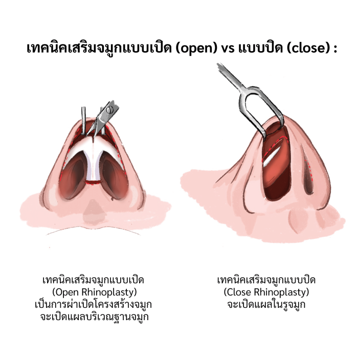 เทคนิคเสริมจมูกแบบเปิด และแบบปิด อีลิทคลินิก