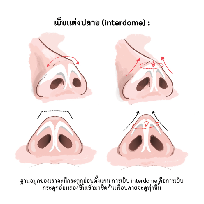 อินเตอร์โดมยังจำเป็นมั้ย อีลิทคลินิก